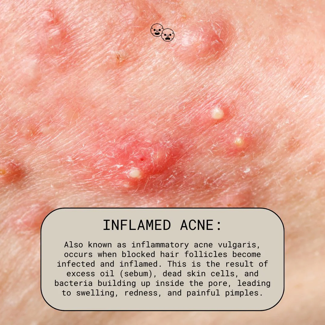 Inflammatory acne with red bumps